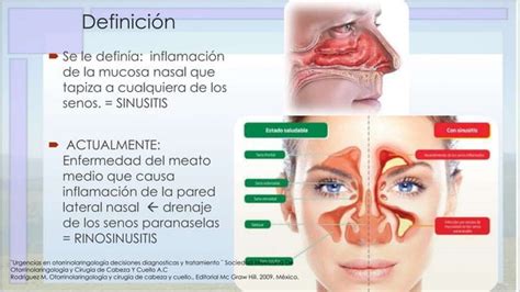 Rinosinusitis Aguda Y Cronica PPT