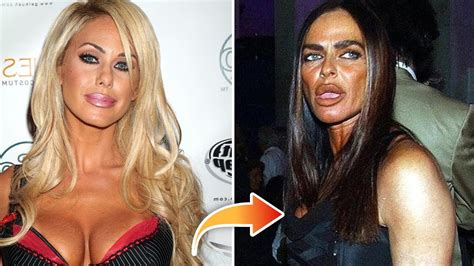 Before And After Celebrity Plastic Surgery Gone Bad