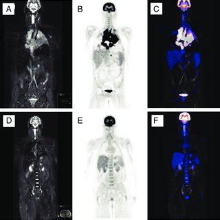 Positron emission tomography (PET)-magnetic resonance imaging was used ... 