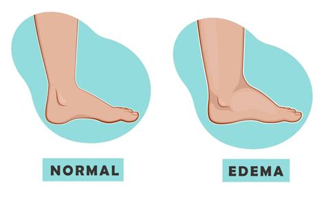 5 Causes Of Swelling In The Feet Feet First Clinic