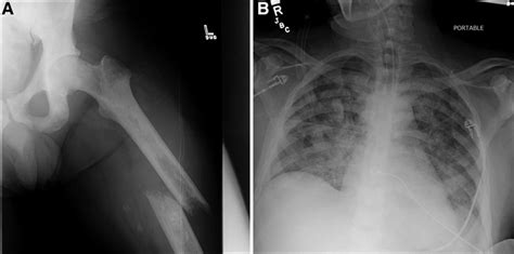 Fat Embolism Syndrome Circulation