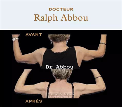 Liposuction Of The Arms In Paris Dr Abbou And Dr Pessis