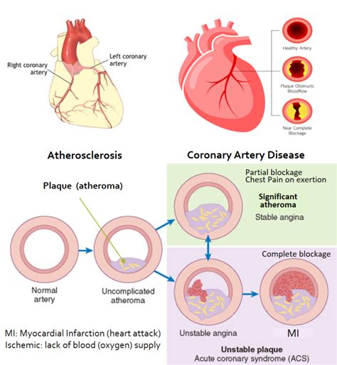 Cardiovascular Disease CVD Understanding Atherosclerosis And