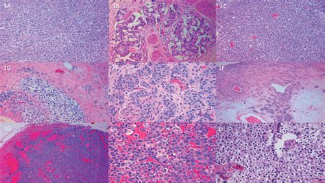 Figure 1 Patterns Of Urothelial Carcinoma Panel Urologic