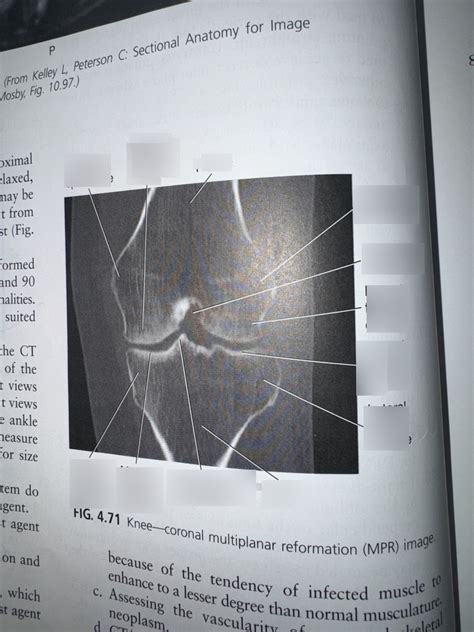 Knee Coronal View Diagram Quizlet