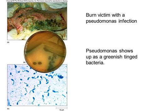 Pseudomonas Aeruginosa Burn Infection