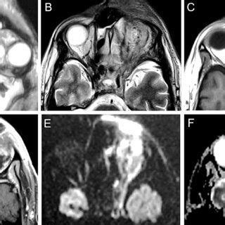 Orbital MRI Of A 58 Year Old Male Patient With Left Covid Associated