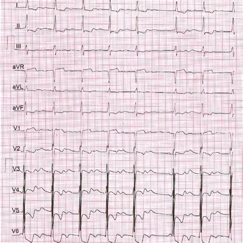 Ecg Showing The Atrial Fibrillation With Lvh Left Ventricular | Sexiz Pix