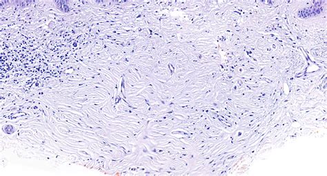 Sccis In Combination With Sclerotic Fibroma Kiko Xp