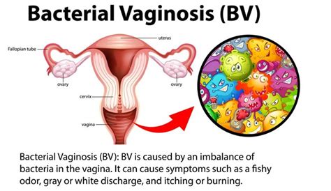 Premium Vector Bacterial Vaginosis Bv Infographic With Explanation