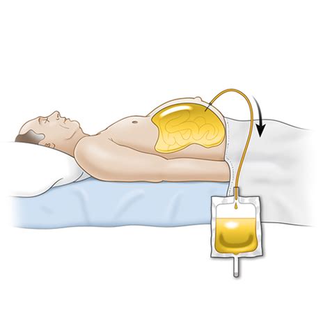 Paracentesis Procedure Training - Ultrasound-Guided Technique