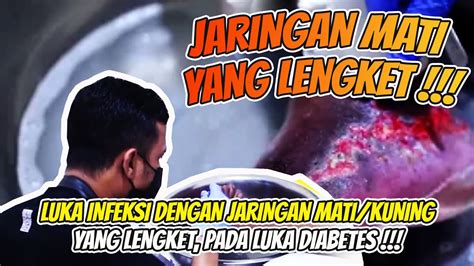 Luka Infeksi Dengan Jaringan Mati Kuning Yang Lengket Begini Cara