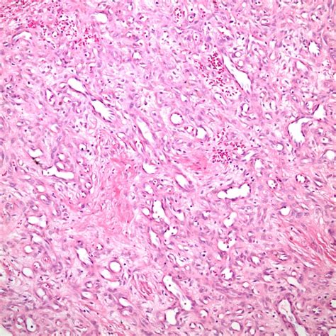 Kaposi Sarcoma Histology