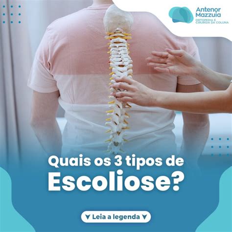 Quais Os 3 Tipos De Escoliose Antenor Mazzuia Ortopedia E Cirurgia