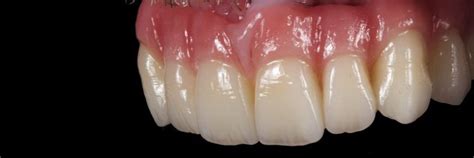 Case 2 - Zirconia Dental Implant Bridge - Before and After Gallery