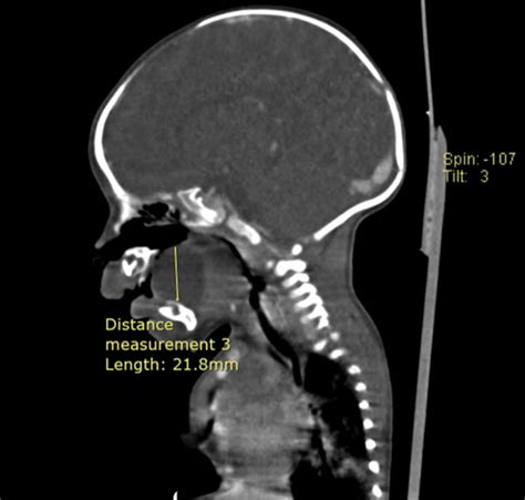 Floor Of Mouth Dermoid Cyst Radiology