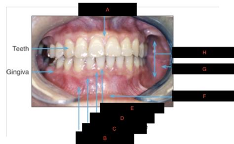 Bms Oral Mucosa And Periodontium Flashcards Quizlet