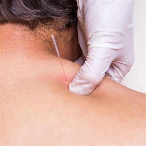 Dry Needling Understanding The Benefits And Effectiveness