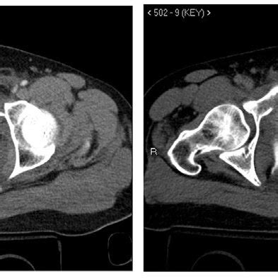 Axial Views Of A Computed Tomography Scan Showing Multiple Fractures Of