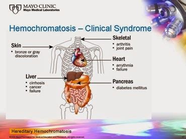 Ashland Human Biology: Hemochromatosis: Iron Overload