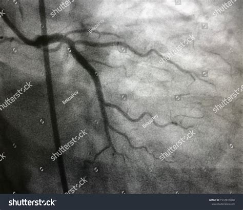 Coronary Angiography St Elevation Myocardial Infarction Stock Photo ...