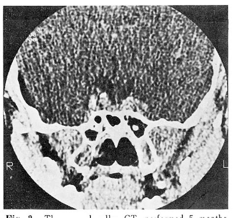 [PDF] Spontaneous rupture of intrasellar cyst demonstrated by CT and MR imaging | Semantic Scholar