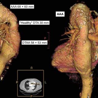 Preoperative Computed Tomography Scan With Three Dimensional