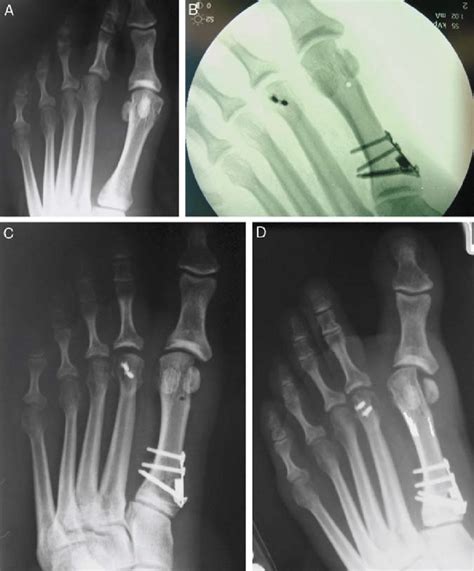 A Preoperative Radiograph B Postoperative Fluoroscopy Demonstrates