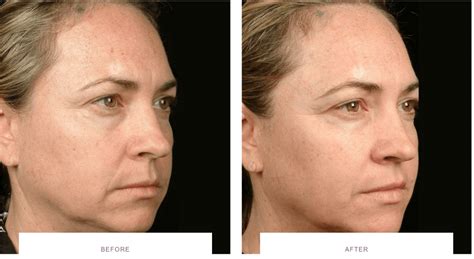 Skin Tightening Procedures For Face