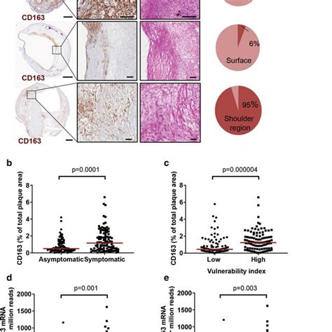 CD163 Is Present In Shoulder Regions Of Human Carotid Plaques And