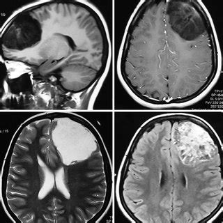 Magnetic Resonance Imaging Brain A T1 Weighted Sagittal Section