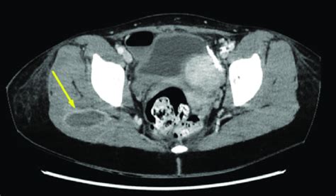 Contrast Enhanced Abdominal Ct Scan Showing An Abscess Within The Right