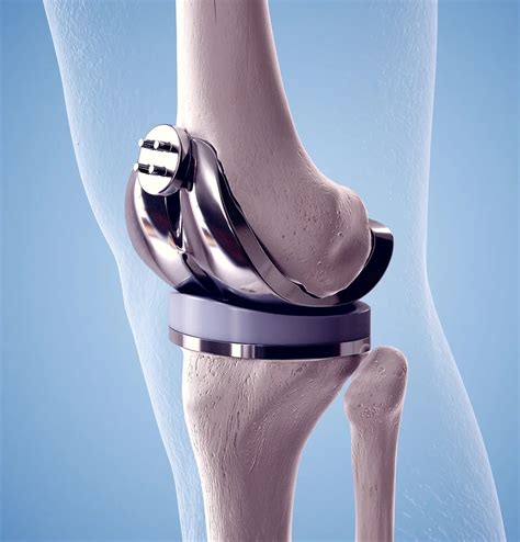 Computer Assisted Knee Replacement Knee Replacement Centurion