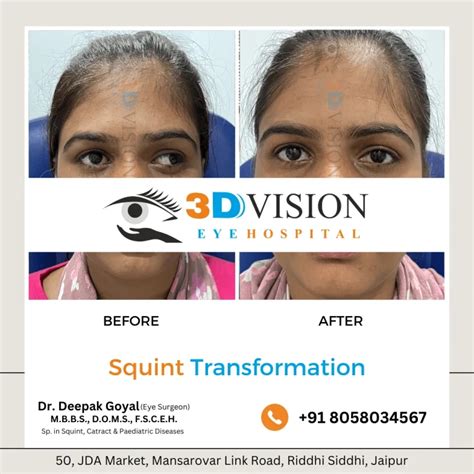 Squint Specialist in Jaipur | Squint Eye Treatment