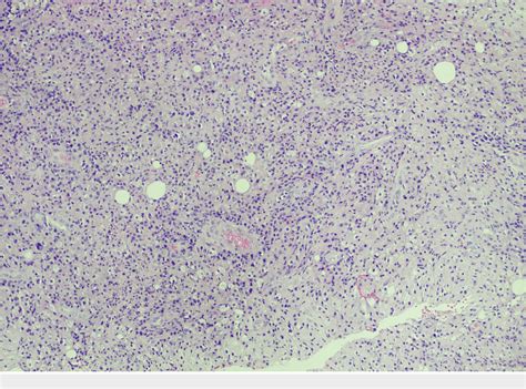 Figure From Clinical Characteristics Of Idiopathic Granulomatous