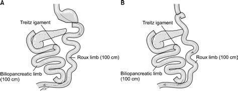 Roux En Y Gastric Bypass Afferent Limb