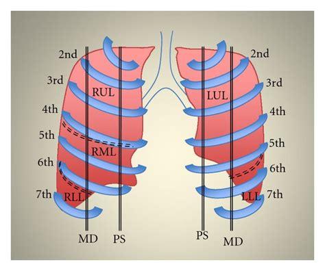 Anterior View Of The Lung Schematic Representation Of Pulmonary Lobes Download Scientific