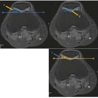 a, b MRI images for grade IV chondromalacia patella with infrapatellar... | Download Scientific ...