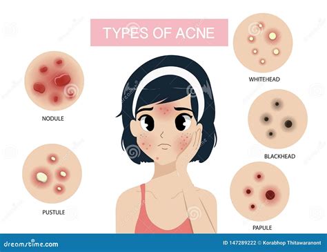 Types Of Acne Pimples Cartoon Vector 101722023