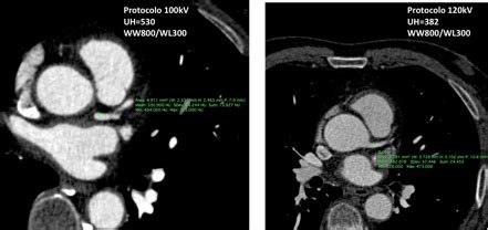 Calidad de imagen y reducción de dosis en angiotomografía computarizada