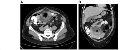 Ct Of The Abdomen With Oral And Iv Contrast A Axial Image Of The Download Scientific Diagram