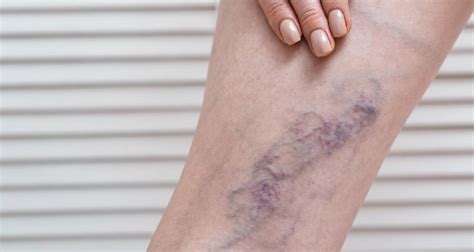 Manchas Roxas Nas Pernas O Que Pode Ser - Manchas roxas nas pernas pode ser leucemia? - MundoBoaForma