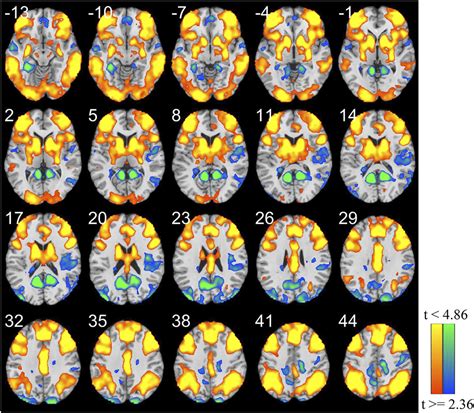 Sex Differences In Neural Substrates Of Risk Taking Implications For