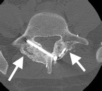 Surgical Repair of Pars Interarticularis Fractures | Spine Surgeon