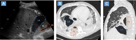 Point Of Care Lung Ultrasound Diagnosis Of Concomitant Lung Abscess And