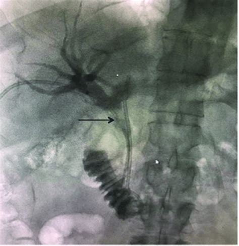 Common bile duct stent partial occlusion with filling defects (fungus... | Download Scientific ...