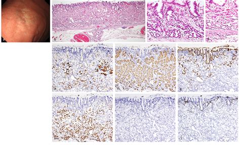 Gastric Adenocarcinoma Of Fundic Gland Mucosa Type Type 3