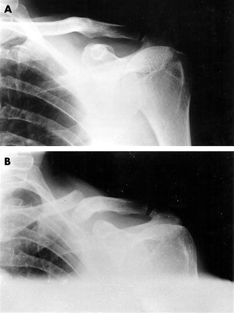 Missed Clavicular Fracture Inadequate Radiograph Or Occult Fracture