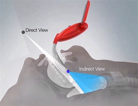 Video And Direct Laryngoscopy Patientsafe Network