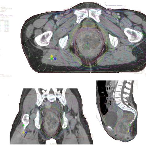 Example Of Pencil Beam Scanning Proton Plan For Patient With Early Download Scientific Diagram